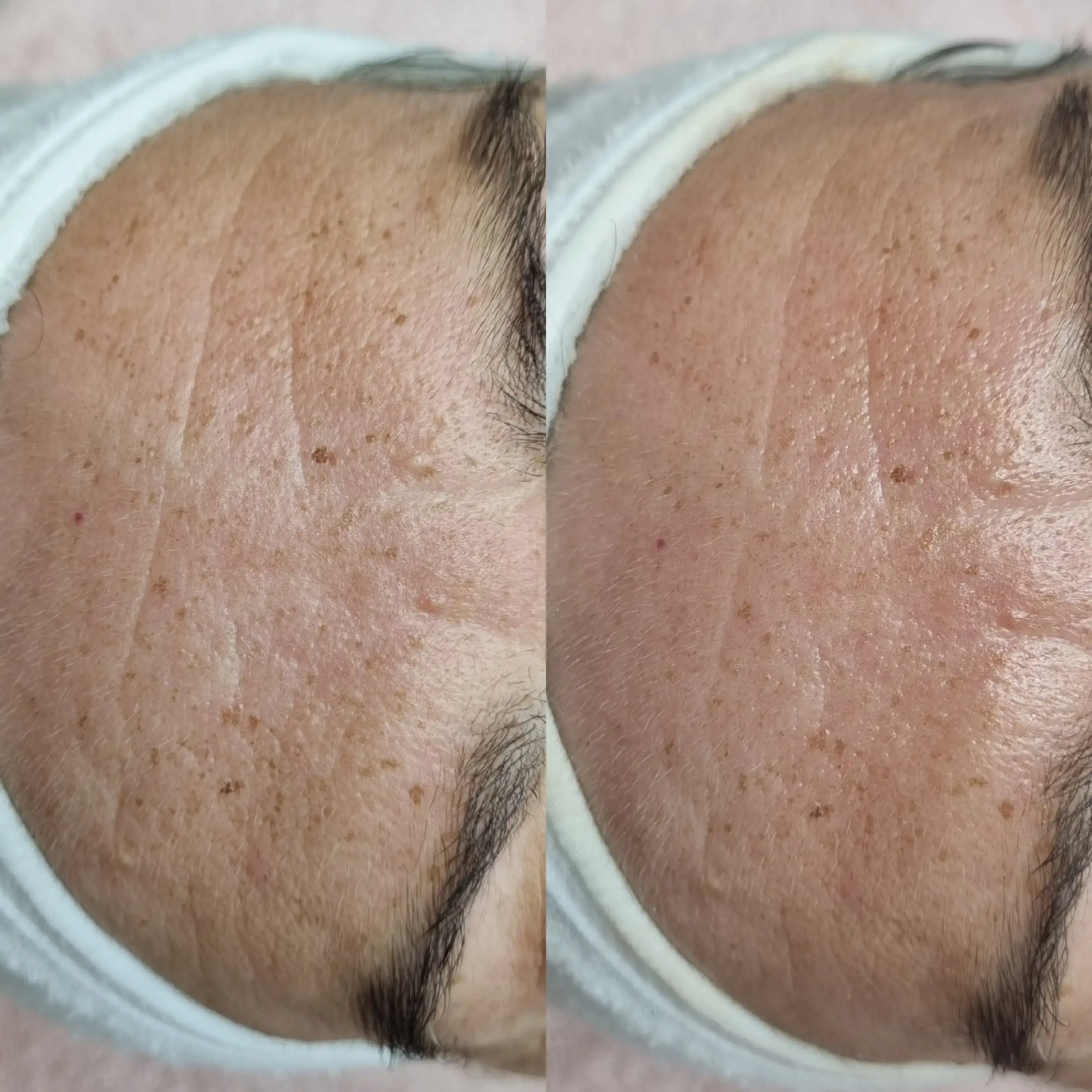 Porównianie skóry po wykonaniu zabiegu wiśniowego od skin expert