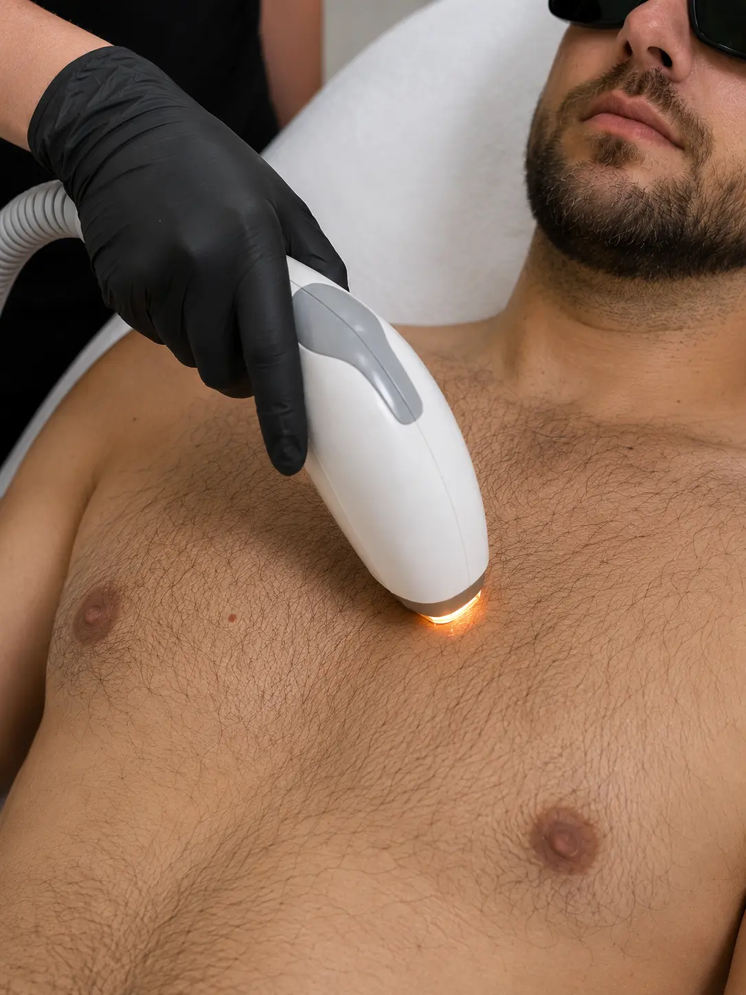 Depilacja laserowa dla mężczyzn